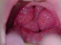 Tonsilectomia cu sau fara adenoidectomie